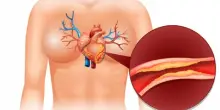 Cuore a rischio, non basta abbassare il colesterolo: le fluttuazioni aumentano infarto e ictus