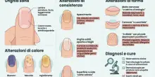 &laquo;Unghie rigate o con le macchie? Potrebbe essere diabete o anemia&raquo;: cosa ci dicono sulla nostra salute