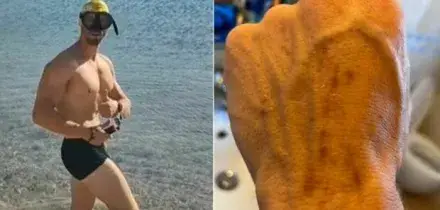 Squalo attacca turista in Sardegna: &laquo;Ho visto una pinna nera, poi mi ha morso cinque volte. Mi stava assaggiando&raquo;