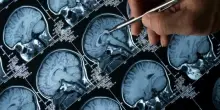 Tumore al cervello, un cerotto intelligente contro il glioblastoma: cos'&egrave; e come funziona