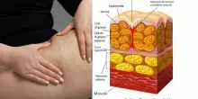 Cellulite &egrave; una malattia? La dottoressa Petrini Rossi: &laquo;Non &egrave; solo estetica, ecco come si pu&ograve; trattare a livello medico&raquo;