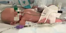 &laquo;Nostro figlio Luca &egrave; nato morto, i medici ci hanno messo un'ora per riportarlo in vita. &Egrave; stato terrificante&raquo;