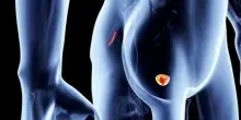 Tumore prostata, trattamento sperimentale uccide le cellule e riattiva l'immunit&agrave;: il nuovo studio americano (e cosa potrebbe cambiare)
