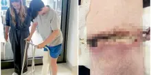 &laquo;Mio figlio di 14 anni infettato dal batterio mangiacarne: si &egrave; tuffato nel lago per il caldo e ha rischiato la morte. Ecco i sintomi&raquo;