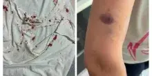 Aggrediti in casa per chiedere il rispetto del posto auto disabili: choc nel Napoletano