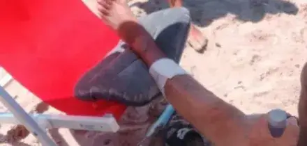Turisti morsi a sangue dai pesci, allarme tra i bagnanti: &egrave; il secondo episodio in pochi giorni