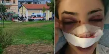 Studentessa aggredita nel parco Rossani a Bari: fratture e 40 giorni di prognosi, la versione di Giuditta