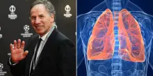Franco Baresi, cosa &egrave; il nodulo ai polmoni per cui fu operato ad agosto 2025: sintomi, diagnosi e prevenzione