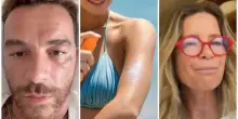 Le creme solari fanno venire i tumori? I casi Salmo e Rasio, cosa dice la scienza (davvero) e la regola ABCDE per i nei sospetti