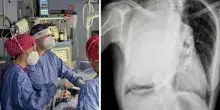 Crede di avere una scoliosi, era un raro tumore di tre chili e mezzo: intervento di 8 ore a Bari