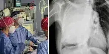 Credeva fosse scoliosi, scopre un tumore di 3,5 chili nel torace