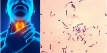Difterite, Bassetti: &laquo;Medici in crisi, difficile da riconoscere&raquo;. Ecco perch&eacute; e le aree a rischio contagio