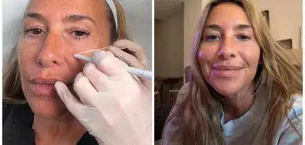 Melanie Blatt, star delle All Saints, lifting non chirurgico a 51 anni: cos'&egrave;, quanto costa e quali sono i risultati