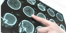 Parkinson, i sintomi da non sottovalutare: diagnosi, cure e aspettative di vita
