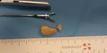 &laquo;Aveva una nocciola bloccata nei bronchi da due settimane&raquo;. Salvata una bambina di 20 mesi operata d'urgenza a Treviso
