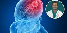 Quando il mal di testa &egrave; il sintomo di un tumore, il neurochirurgo: &laquo;Ecco come accorgersene&raquo;. Cure e sopravvivenza