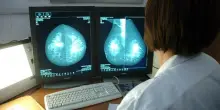 Tumore al seno, nuove cure e terapie sempre pi&ugrave; efficaci: perch&eacute; la diagnosi precoce resta fondamentale