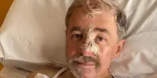 Marco Bucci operato al naso dopo un basalioma: ricostruzione cutanea riuscita