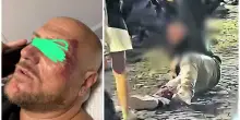 Napoli, padre aggredito da 10 ragazzini per difendere le figlie: operato per evitare l'amputazione della gamba