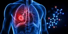 Adenocarcinoma polmonare, il tumore maligno al polmone pi&ugrave; comune nell'uomo: cos'&egrave;, cause, sintomi, diagnosi e trattamento
