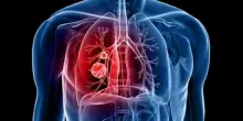 Tumore al polmone, la nuova terapia orale Divarasib riduce del 44% il rischio di morte: cos'&egrave;, effetti collaterali, come funziona
