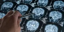 Nuova arma contro il glioblastoma, uno dei tumori cerebrali più aggressivi 'attaccato' dai linfociti T
