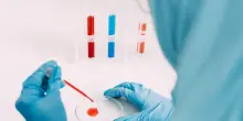 Alzheimer, test su proteina spia del sangue funziona anche per la popolazione asiatica
