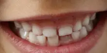 L'inquinamento da metalli &egrave; dannoso per i bambini, lo dicono i denti da latte