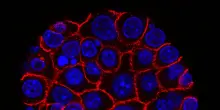 Tumore al pancreas, trovata la proteina che lo rende resistente ai farmaci