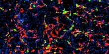 Nanoparticelle efficaci contro il tumore della prostata, uccidono le cellule
