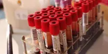 Un eccesso del dolcificante xilitolo nel sangue associato a rischio di infarto o ictus