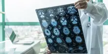 In Italia 100mila casi l'anno di ictus, come riconoscerlo