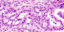 Le cellule del tumore del pancreas si travestono per sfuggire ai farmaci
