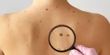 Melanoma, primo vaccino 'su misura' riduce il rischio di recidiva del 42%
