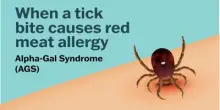 Se una zecca rende allergici a carne e latticini, cosè la sindrome alfa-gal
