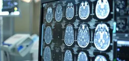 Ictus, esperti: "Asundexian apre nuovo capitolo prevenzione secondaria"