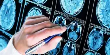 Alzheimer, 300mila euro a 6 scienziati per diagnosi precoce e prevenzione