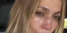 Jennifer Lopez si rompe il naso durante le prove e corre dal chirurgo