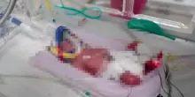 Australia, parto record: 4 gemelle identiche nella stessa placenta: "Un caso su 15 milioni"