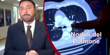 Noduli polmonari, quando intervenire e come