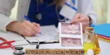Tumori rari e al colon: nuovo farmaco aiuta diagnosi precoce e cura