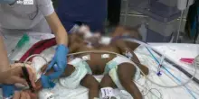 Gemelle siamesi separate al Gaslini di Genova