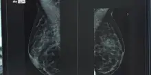 Cancro al seno, Health Triage sviluppa uno screening con I.A.