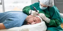 Trapianti di capelli, business in crescita in tutta Europa. I dati