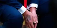 Usa, Trump e il livido sulla mano: i repubblicani chiedono risposte