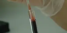 Nuovo test del sangue per "scovare" le malattie genetiche