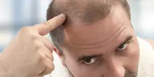 Addio alla calvizie, i capelli ricrescono con nuove terapie cellulari