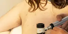 In 20 anni i casi di melanoma in Italia sono più che raddoppiati