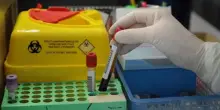 Alzheimer, via libera a test del sangue per diagnosi: cosa significa