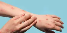 Come alleviare una puntura d'insetto?